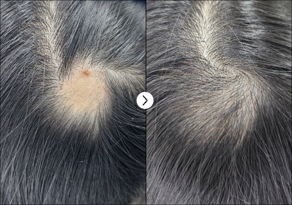 Ribeskin Hairlopecia Meso Complex & Micro Silica Spicule