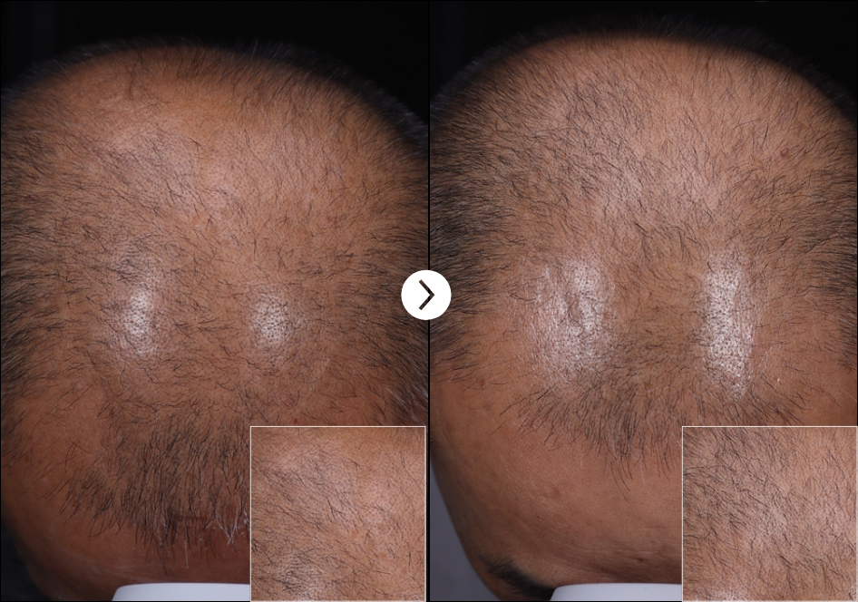 Ribeskin Hairlopecia Meso Complex & Micro Silica Spicule