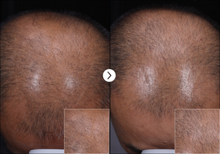 Ribeskin Hairlopecia Meso Complex & Micro Silica Spicule